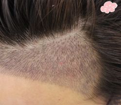 -大麦微针植发丨全国连锁