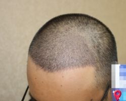 -大麦微针植发丨全国连锁