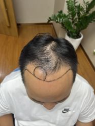 体验前-大麦微针植发全国连锁