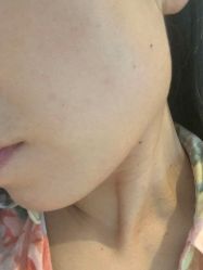 -爱莎扁平疣·汗管瘤·斑痣中心