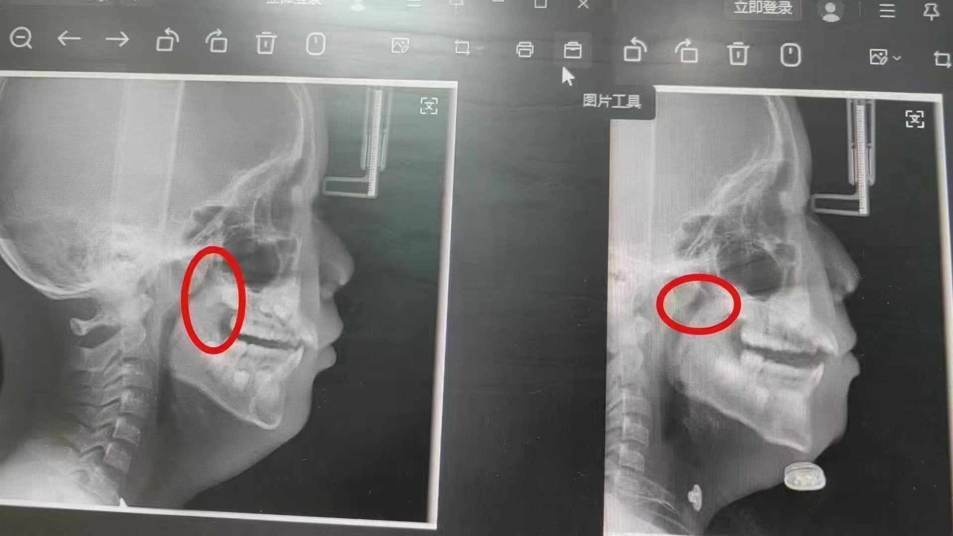 腺样体肥大可以不用手术