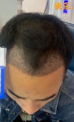 -大麦微针植发丨全国连锁