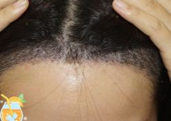 -大麦微针植发丨全国连锁