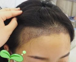 -大麦微针植发丨全国连锁