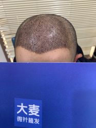 -大麦微针植发丨全国连锁