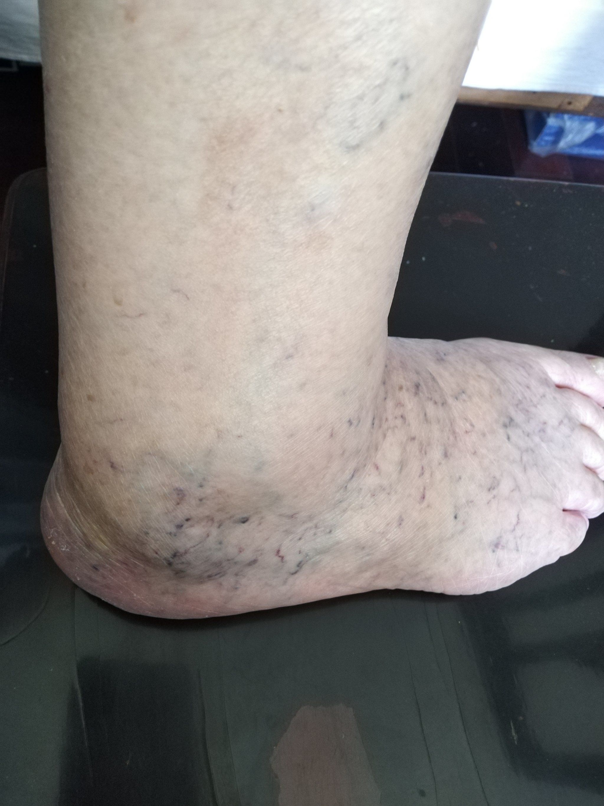 看看这些静脉曲张照片