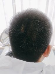 -大麦微针植发丨全国连锁