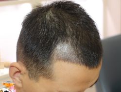 -大麦微针植发丨全国连锁