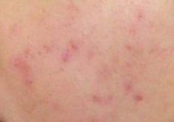 -成都军建医院·疤痕诊疗中心