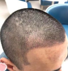 -大麦微针植发丨全国连锁