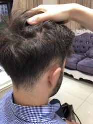 -大麦微针植发丨全国连锁