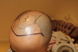 -大麦微针植发丨全国连锁