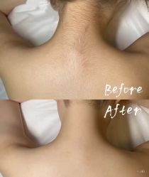 -薇兰专业脱毛连锁机构