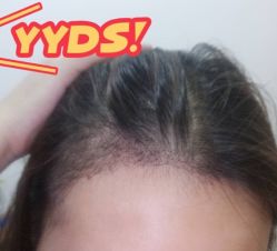 -大麦微针植发丨全国连锁