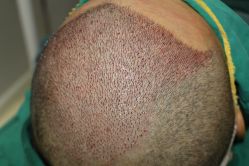 -大麦微针植发丨全国连锁