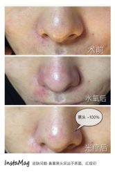 点击看大图 项目:水氧+OPT光疗。治疗范围:深层清洁皮肤垃圾,给皮肤注水补养,美白嫩肤收缩毛孔去黑头淡化色沉和痘印。-光SPA科技美肤