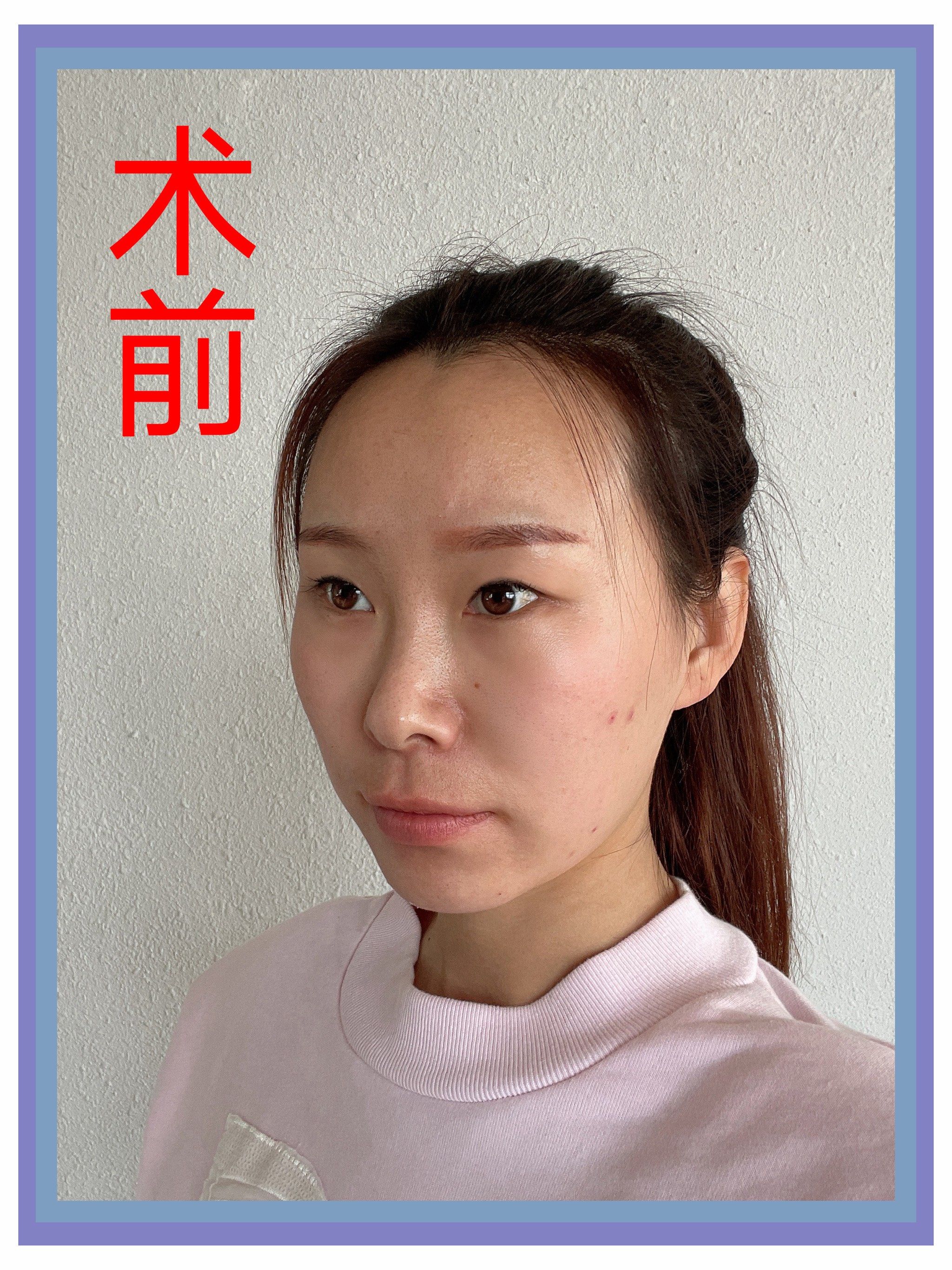 【眼综合】术后30天效果分享