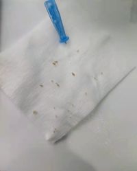 体验后-肌密·水光·祛痘·黄金微针