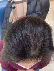 体验后-大麦微针植发丨全国连锁