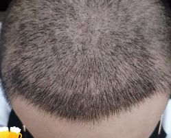 -大麦微针植发丨全国连锁