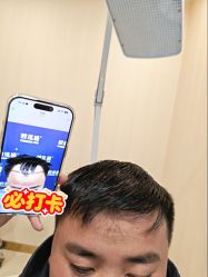 -碧莲盛·不剃发植发