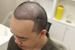-大麦微针植发丨全国连锁
