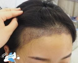 -大麦微针植发丨全国连锁