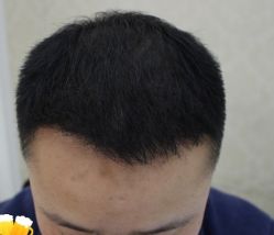 -大麦微针植发丨全国连锁