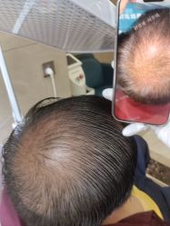 -碧莲盛·不剃发植发