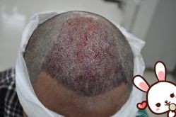 -大麦微针植发丨全国连锁