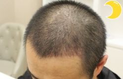 -大麦微针植发丨全国连锁