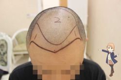 -大麦微针植发丨全国连锁