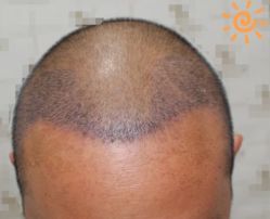 -大麦微针植发丨全国连锁