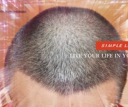 -大麦微针植发全国连锁