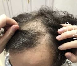 -大麦微针植发全国连锁