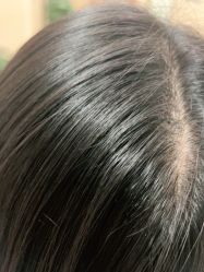 点击看大图 -碧莲盛·不剃发植发