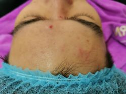 -蕾特恩祛痘•皮肤管理