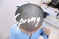 体验后-大麦微针植发全国连锁