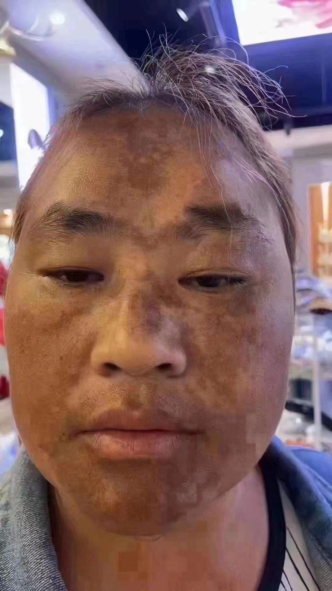 严重的铅汞中毒斑!网购一时爽歪歪,后期苦哈哈