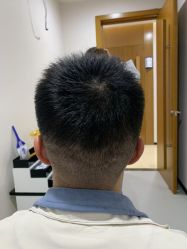 -大麦微针植发全国连锁