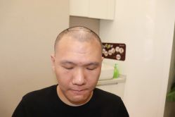 点击看大图 -大麦微针植发丨全国连锁