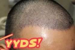 -大麦微针植发丨全国连锁