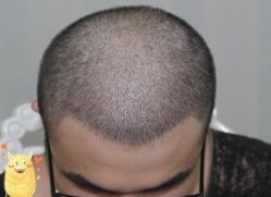 -大麦微针植发丨全国连锁