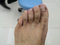 -派恩宜灰指甲鸡眼嵌甲手足癣