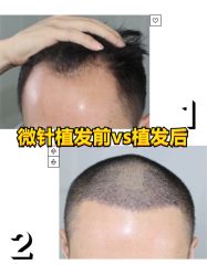 -大麦微针植发全国连锁