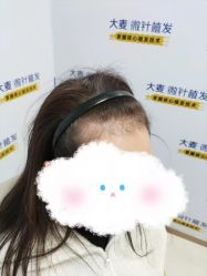 -大麦微针植发丨全国连锁