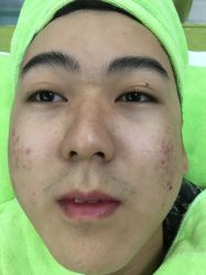 -苗医生草本科技祛痘