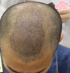 -大麦微针植发丨全国连锁