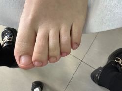 -德哥灰指甲脚气甲沟炎跖疣护理