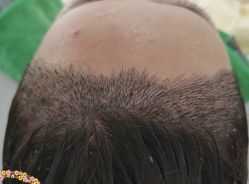 -大麦微针植发丨全国连锁